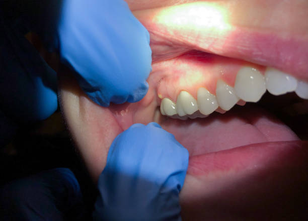 Best Emergency Treatment for Dental Infections or Abscesses in Blplay, AL